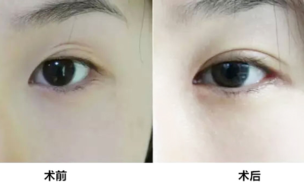 切開雙眼皮手術(shù)做失敗了怎么辦?