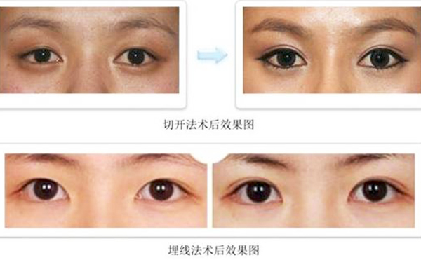雙眼皮埋線和切開(kāi)哪個(gè)比較好?疼痛程度有什么不同？