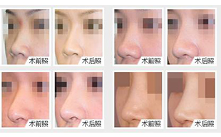 玻尿酸隆鼻好還是假體隆鼻好？更推薦哪一種？