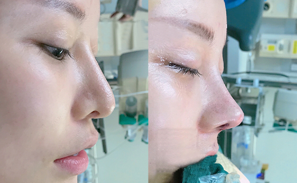 隆鼻失敗的原因是什么？隆鼻修復(fù)方法有哪些？