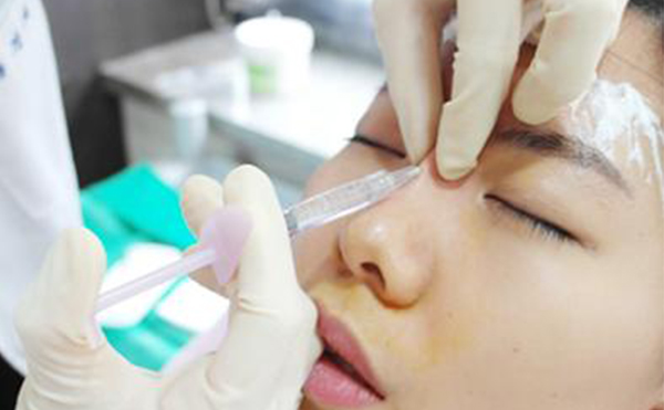 玻尿酸隆鼻大概要花多少錢？能維持多久？