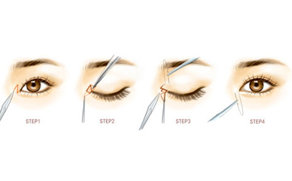 開內(nèi)眼角是什么價格?術(shù)后有什么注意事項?