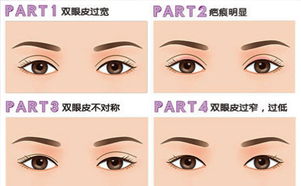 雙眼皮失敗有哪些明顯表現(xiàn)？修復成功率大嗎？