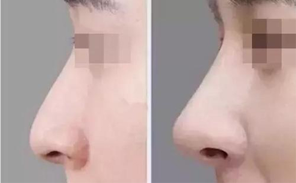 隆鼻前應(yīng)該做什么準(zhǔn)備確保有好的手術(shù)效果？