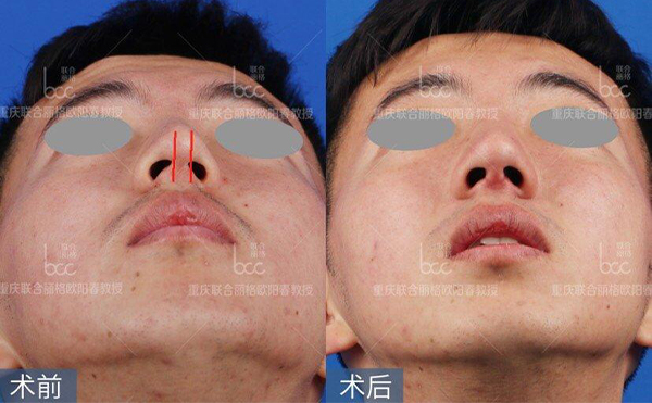 歪鼻修復(fù)術(shù)要多少錢(qián)？