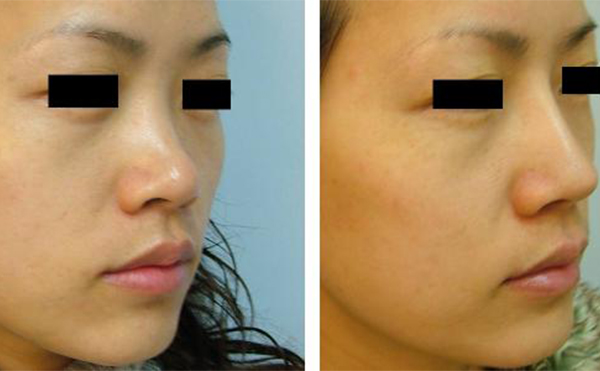 隆鼻手術有沒有什么后遺癥？