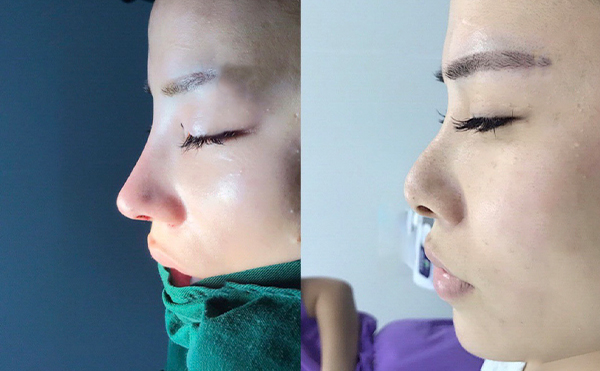 做隆鼻手術(shù)需要滿足什么條件？月經(jīng)期間可以做隆鼻手術(shù)嗎？