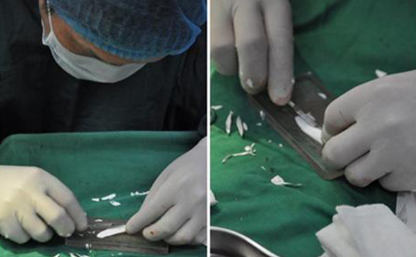 做隆鼻手術(shù)疼不疼?