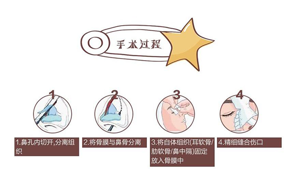 自體軟骨隆鼻為什么這么受歡迎？