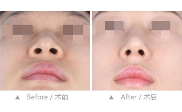 鼻孔縮小整形是怎么做的？效果好不好？