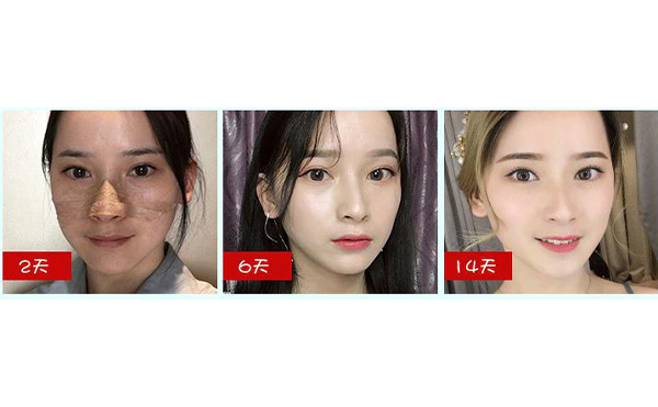 全肋鼻和半肋鼻有什么區(qū)別？做全肋好還是半肋好