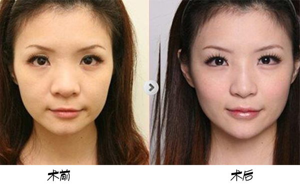 為保證鼻頭肥大矯正手術(shù)效果，術(shù)前術(shù)后應(yīng)該注意些什么？