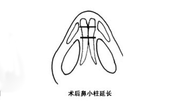 鼻小柱延長(zhǎng)可靠嗎？手術(shù)難度大嗎