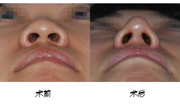 鼻小柱延長手術(shù)的大致流程是什么？手術(shù)成功率高嗎