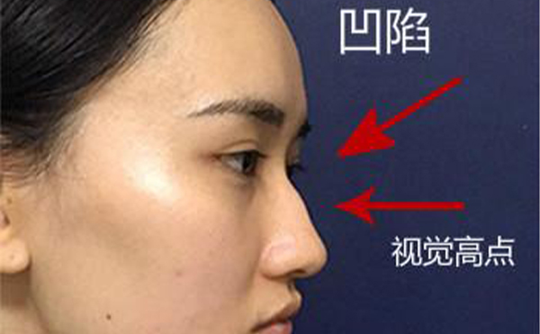 駝峰鼻整形是怎么做的？不同嚴(yán)重程度的駝峰鼻矯正方法一樣嗎？