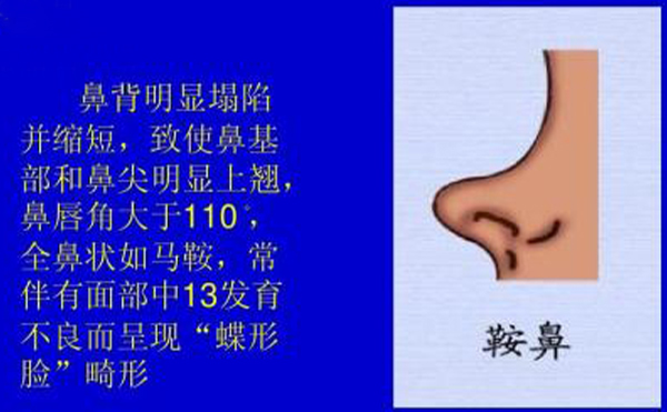 鞍鼻長什么樣子?哪些人需要做鞍鼻矯正手術(shù)?
