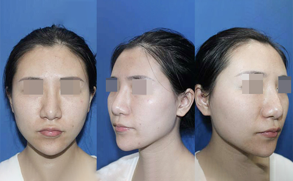 為保證手術(shù)效果鼻頭肥大整形術(shù)前術(shù)后應(yīng)注意什么