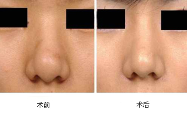 縮小鼻頭有什么辦法?為什么說一定要選擇正規(guī)醫(yī)院醫(yī)生做手術
