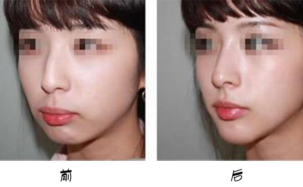 箭鼻是怎么出現(xiàn)的?箭鼻矯正是如何操作的？