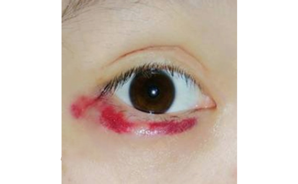 自體脂肪豐臥蠶有風(fēng)險(xiǎn)嗎?術(shù)后怎么護(hù)理?