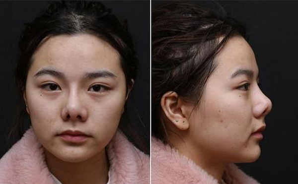 隆鼻是不是都需要做修復?