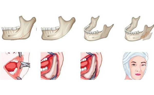 哪些人不能做下頜角切除手術(shù)？