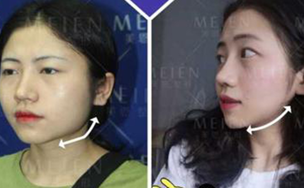 下頜角整形遠沒有你想的那么安全，風(fēng)險不是一般的大