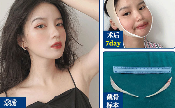 磨骨整形術(shù)后注意事項(xiàng)