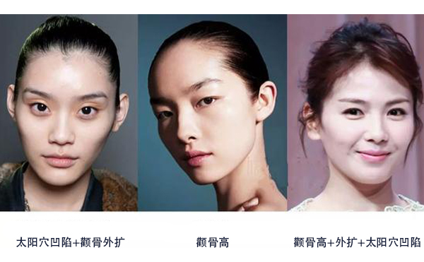 怎么區(qū)分是顴骨高還是太陽(yáng)穴凹陷？