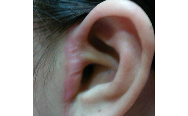 拉皮痕跡明顯嗎？