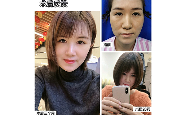 電波拉皮除皺的步驟是什么？