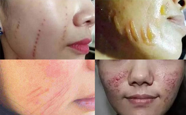 超聲刀有副作用嗎？