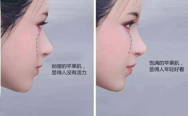 蘋果肌凹陷怎么辦？