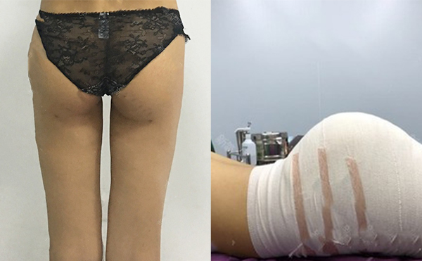 做假體豐臀有沒有年齡限制?哪些人不適合做假體豐臀?