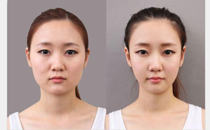 非手術(shù)瘦臉多少錢？非手術(shù)瘦臉方法有哪些？