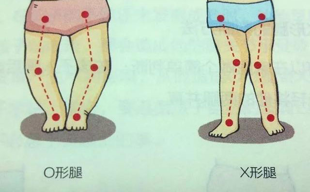 羅圈腿怎樣矯正？羅圈腿手術(shù)矯正多少錢(qián)？