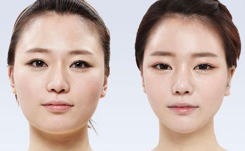 顴骨整形要多少錢？