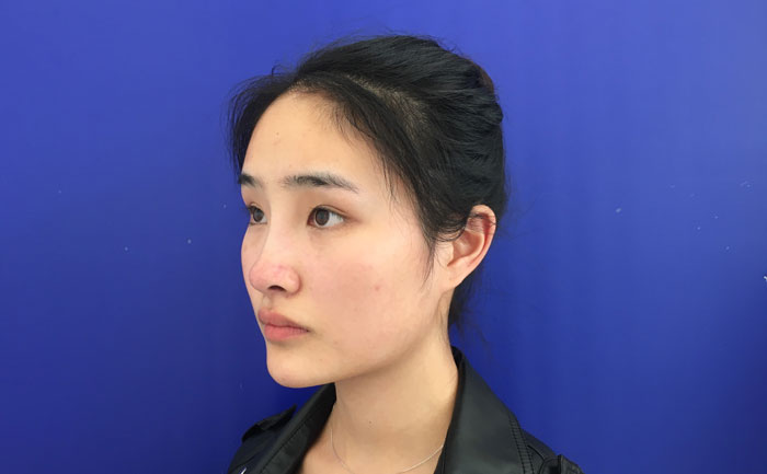 墊下巴一般多少錢？