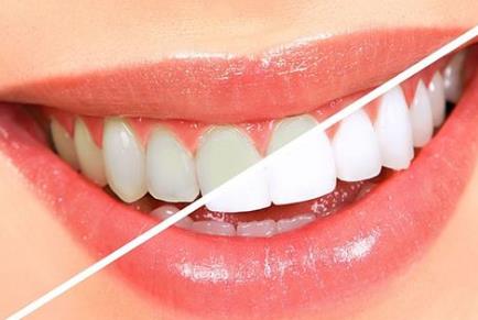 做牙冠多少錢(qián)一顆？