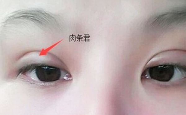雙眼皮不自然怎么補(bǔ)救？雙眼皮肉條好修復(fù)么？