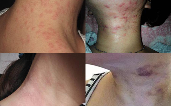 嗨體去頸紋有什么副作用？