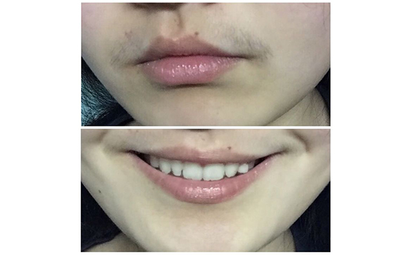 冰點(diǎn)面部脫毛會影響毛孔嗎？