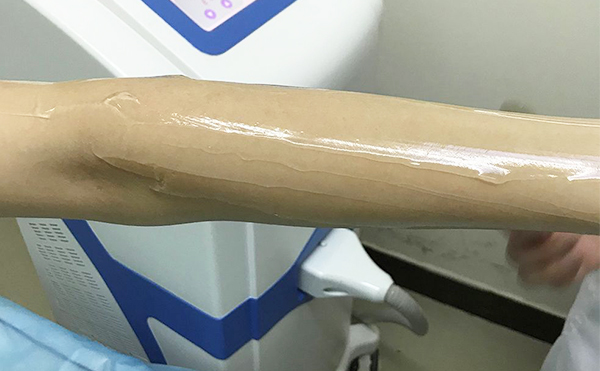 冰點(diǎn)脫毛的步驟是什么?有哪些需要注意的?