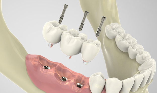 種植牙多少錢一顆牙？