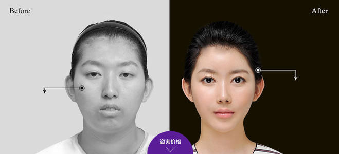 下頜角整形的方法有哪些？