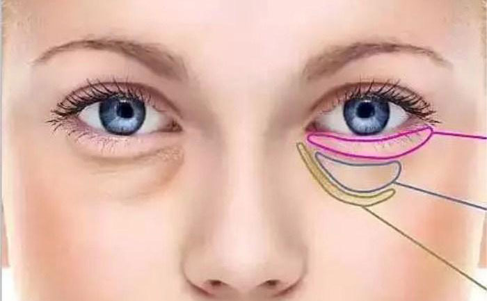 臥蠶跟眼袋怎么區(qū)分？臥蠶和眼袋有什么區(qū)別？