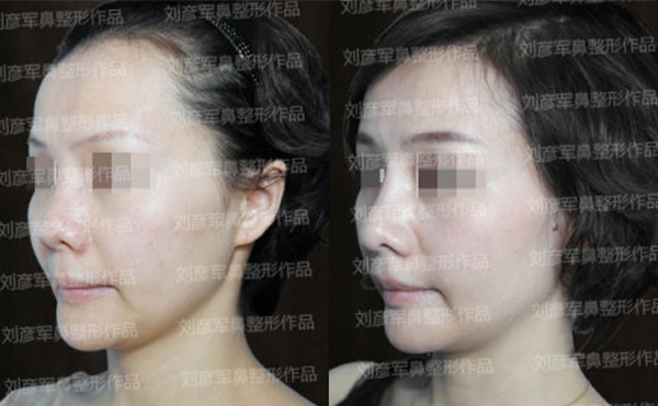 隆鼻失敗的修復(fù)費(fèi)用是多少?