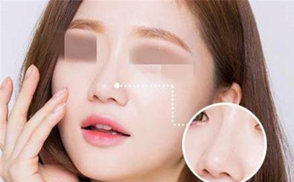 合肥壹加壹整形：出現(xiàn)以下7種情況就是隆鼻失敗了