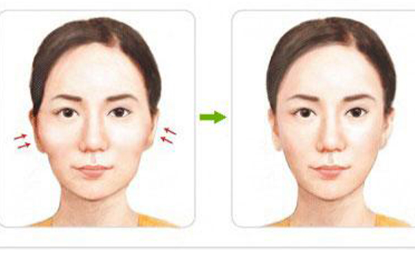 顴骨整形術(shù)后相關(guān)的護理工作有哪些?