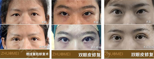 武漢卓美雙眼皮修復(fù)效果
